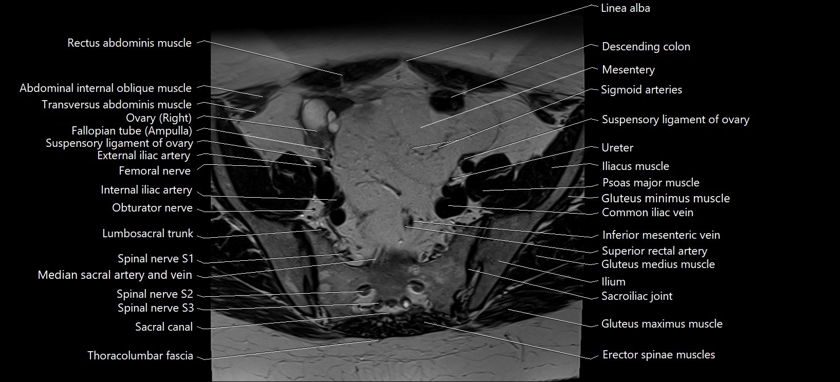 Axial cross sectional anatomy of female pelvis (MRI 3T) image 4.webp